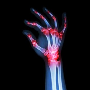 RA, Rheumatoid Arthritis, RA Risk Factors