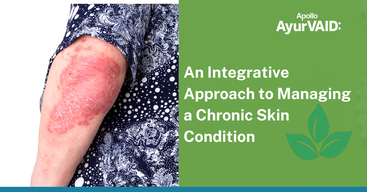 An Integrative Approach to Managing a Chronic Skin Condition